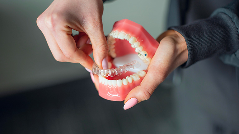 Invisalign For Teens In Iowa City Ia